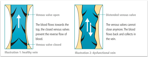 vein disorder