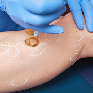 Endovenous laser therapy is a minimal invasive method.