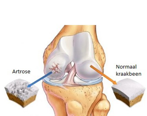 Bij artrose bestaat kraakbeenschade samen met botveranderingen/-schade.